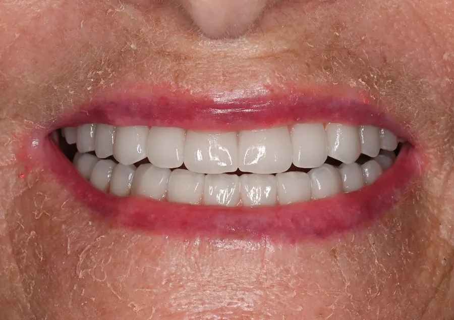After: the same smile with a full, even arch of new teeth.