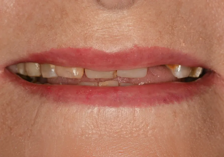 Before: a smile with several missing and broken upper teeth.