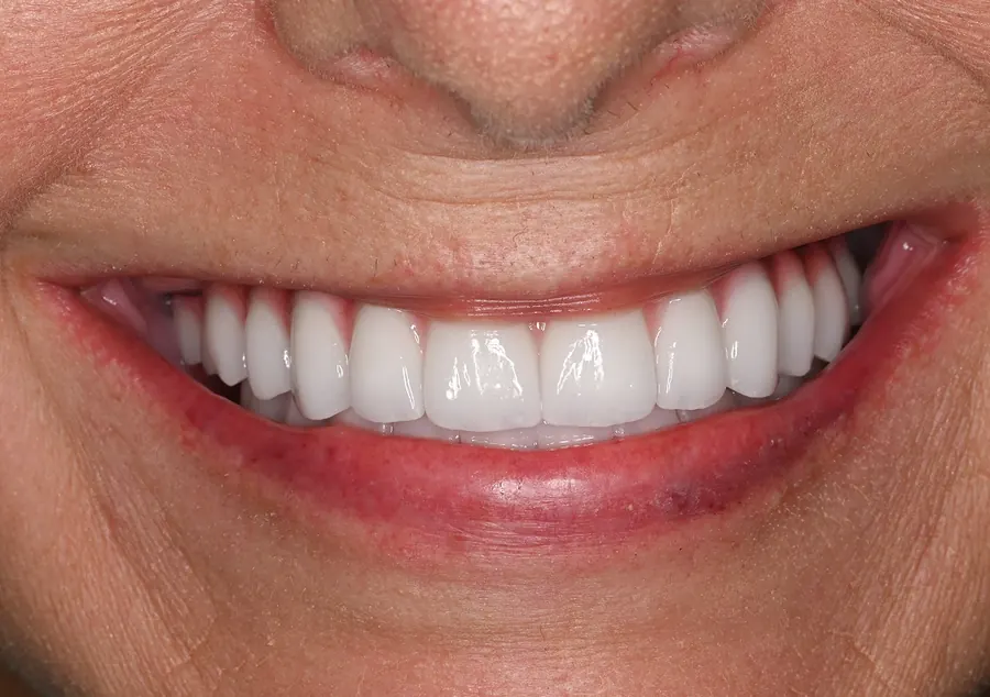 After: the same smile with bright, even new teeth.
