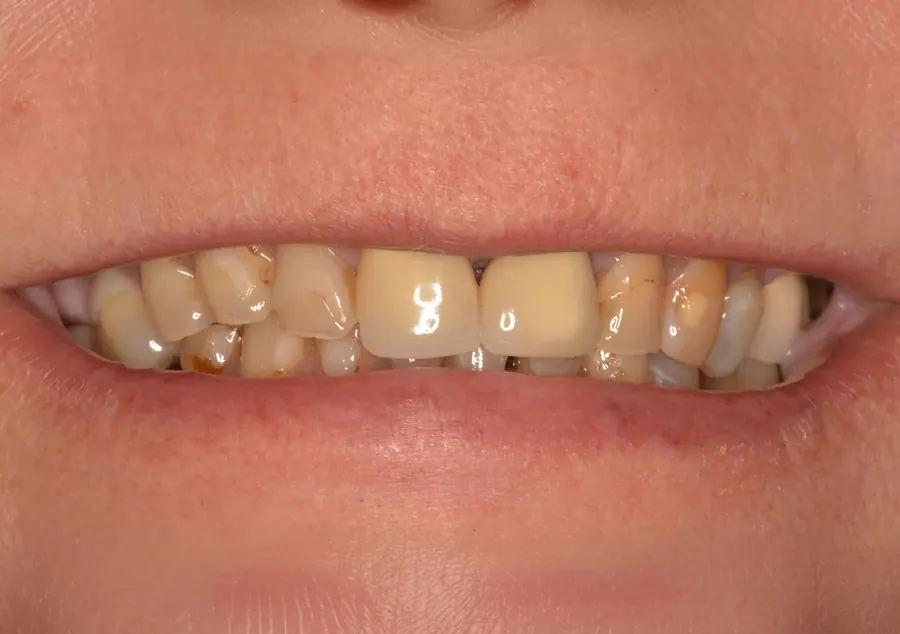 Before: worn, yellowed and uneven teeth.