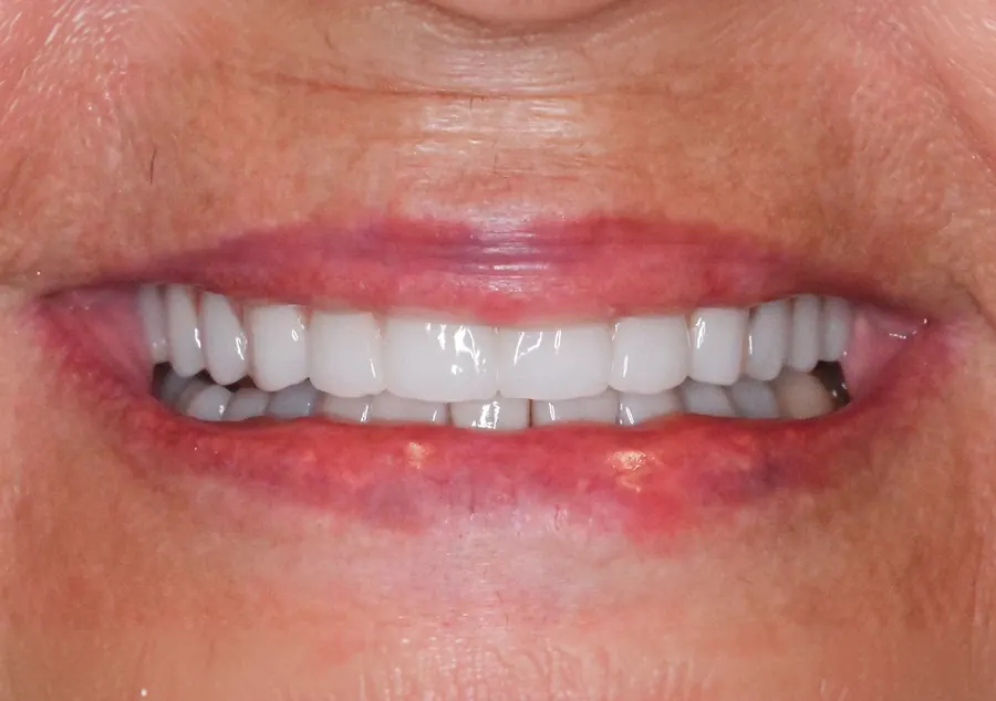 After: the same smile with a new, even full arch.