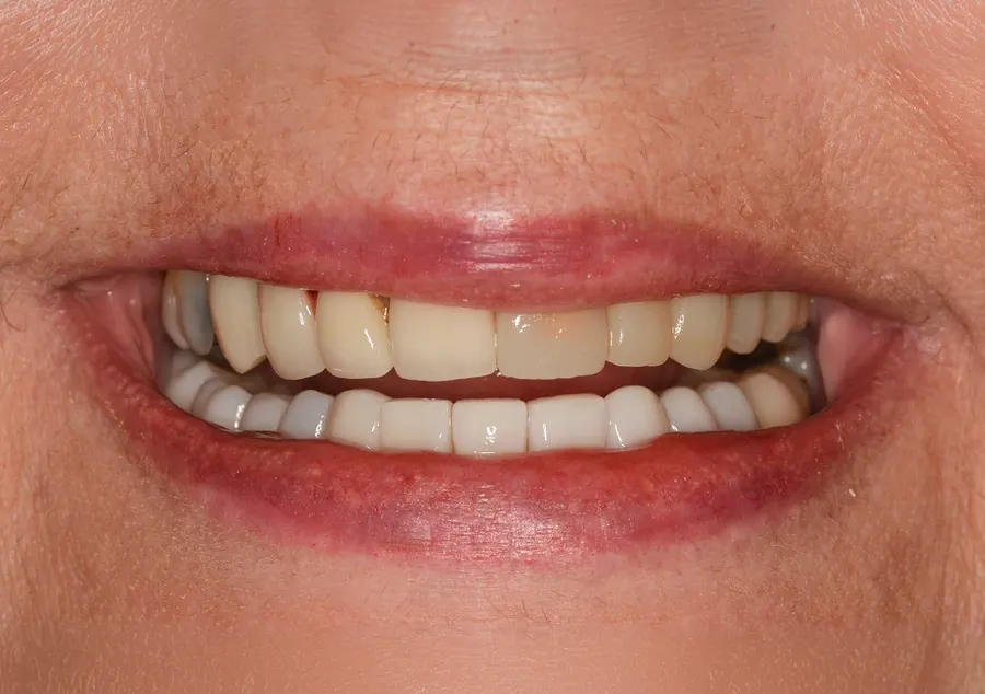 Before: worn and stained teeth with uneven edges.